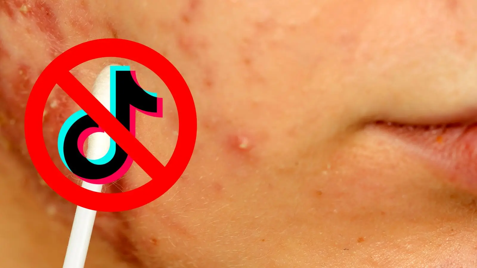 TikTok acne